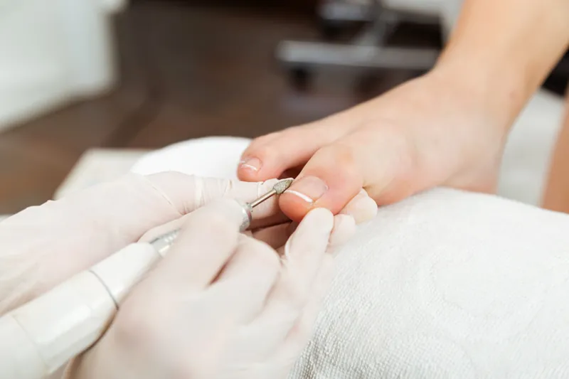 Präzise Behandlung eines Zehennagels
